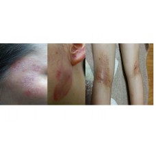Eczema/Atopic Dermatitis Skin Rejuvenation : 1 Month Supply - ECZ  (4) , CP (2)